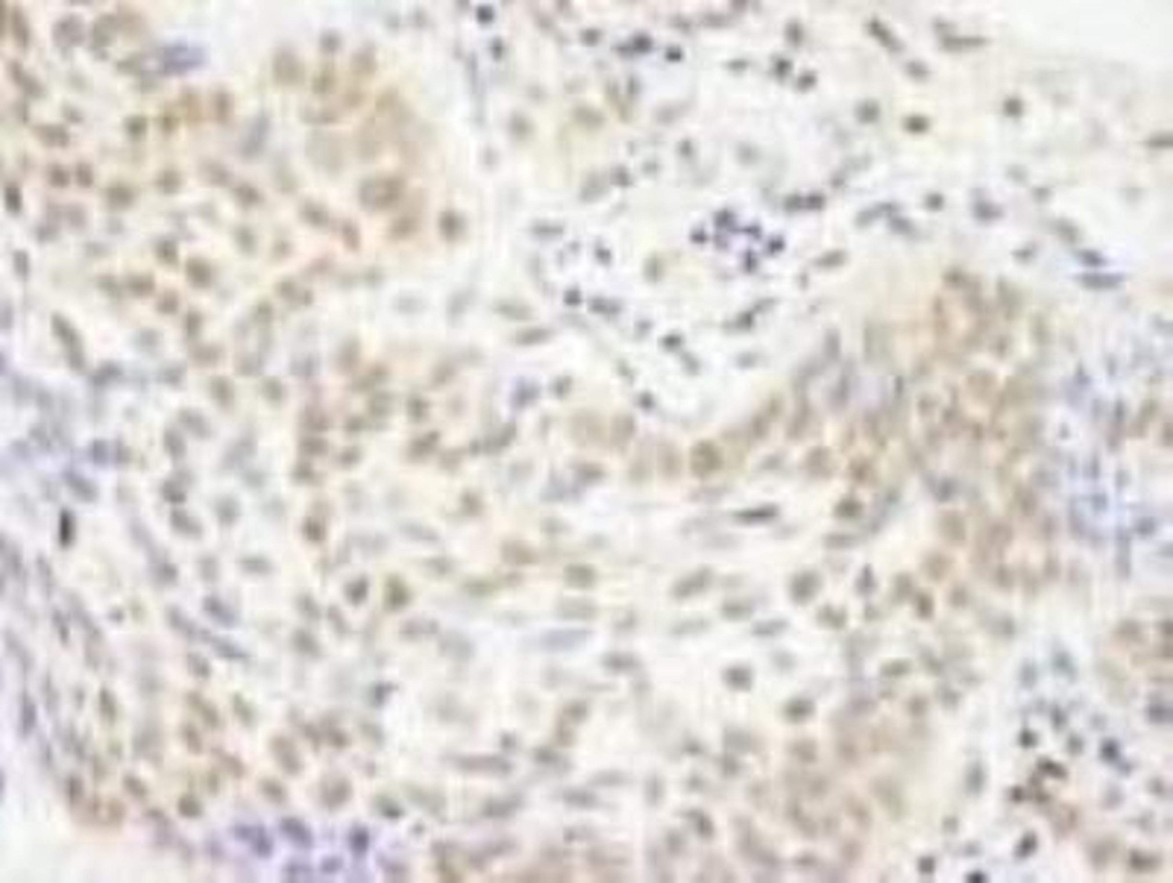 Immunohistochemistry-Paraffin: KDM2A/FBXL11 Antibody [NB100-74602] - FFPE section of human skin basal cell carcinoma.  Affinity purified rabbit anti-JHDM1A  used at a dilution of 1:250.