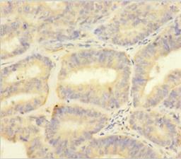 Immunohistochemistry of paraffin-embedded human endometrial cancer using CSB-PA020622HA01HU at dilution of 1:100