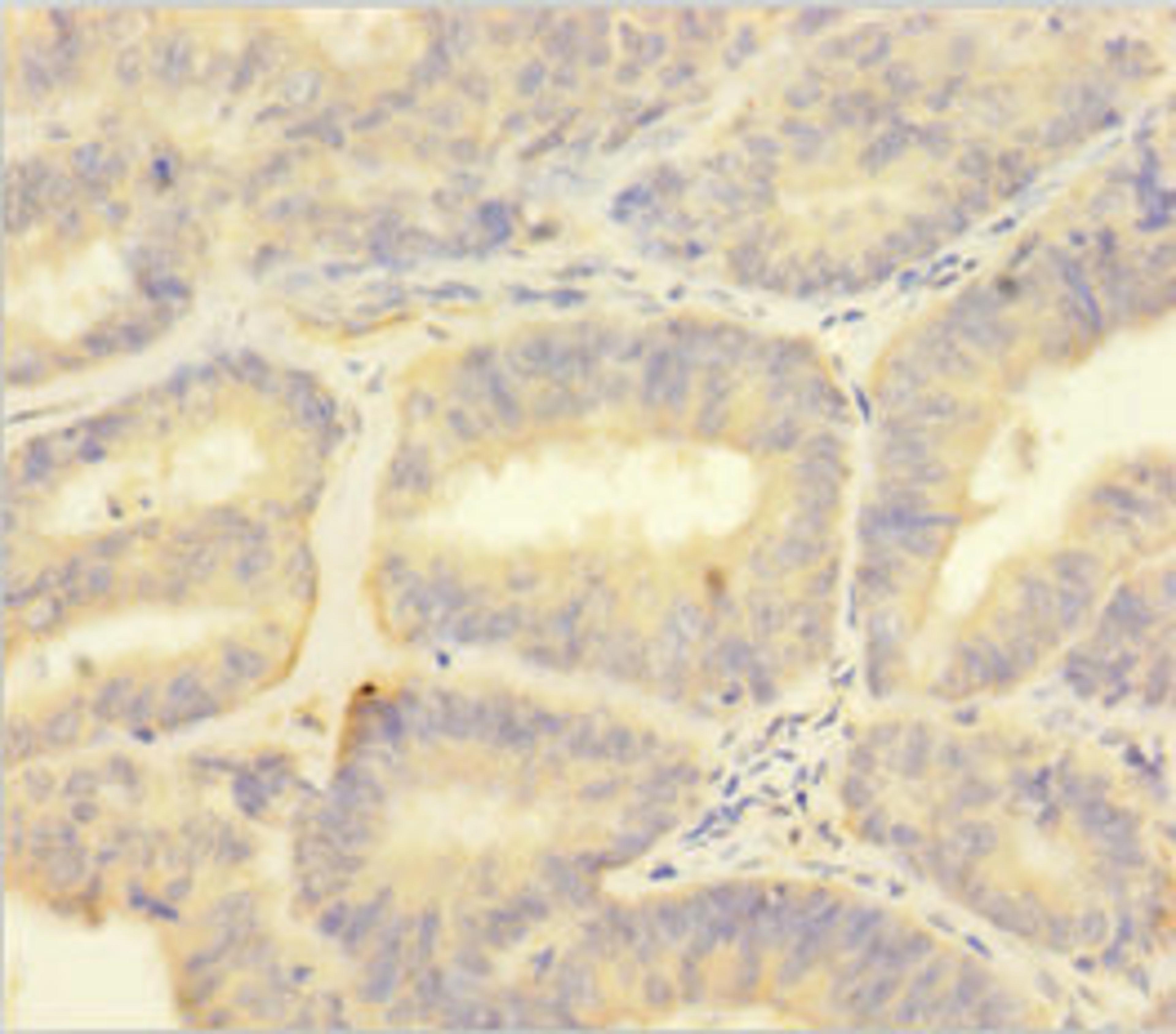 Immunohistochemistry of paraffin-embedded human endometrial cancer using CSB-PA020622HA01HU at dilution of 1:100