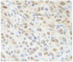 Immunohistochemistry-Paraffin: Sin1/MAPKAP1 Antibody [NB110-40424] -  FFPE section of mouse squamous cell carcinoma. Antibody: Affinity purified rabbit anti-Sin1 used at a dilution of 1:100. Detection: DAB staining using Immunohistochemistry Accessory Kit.