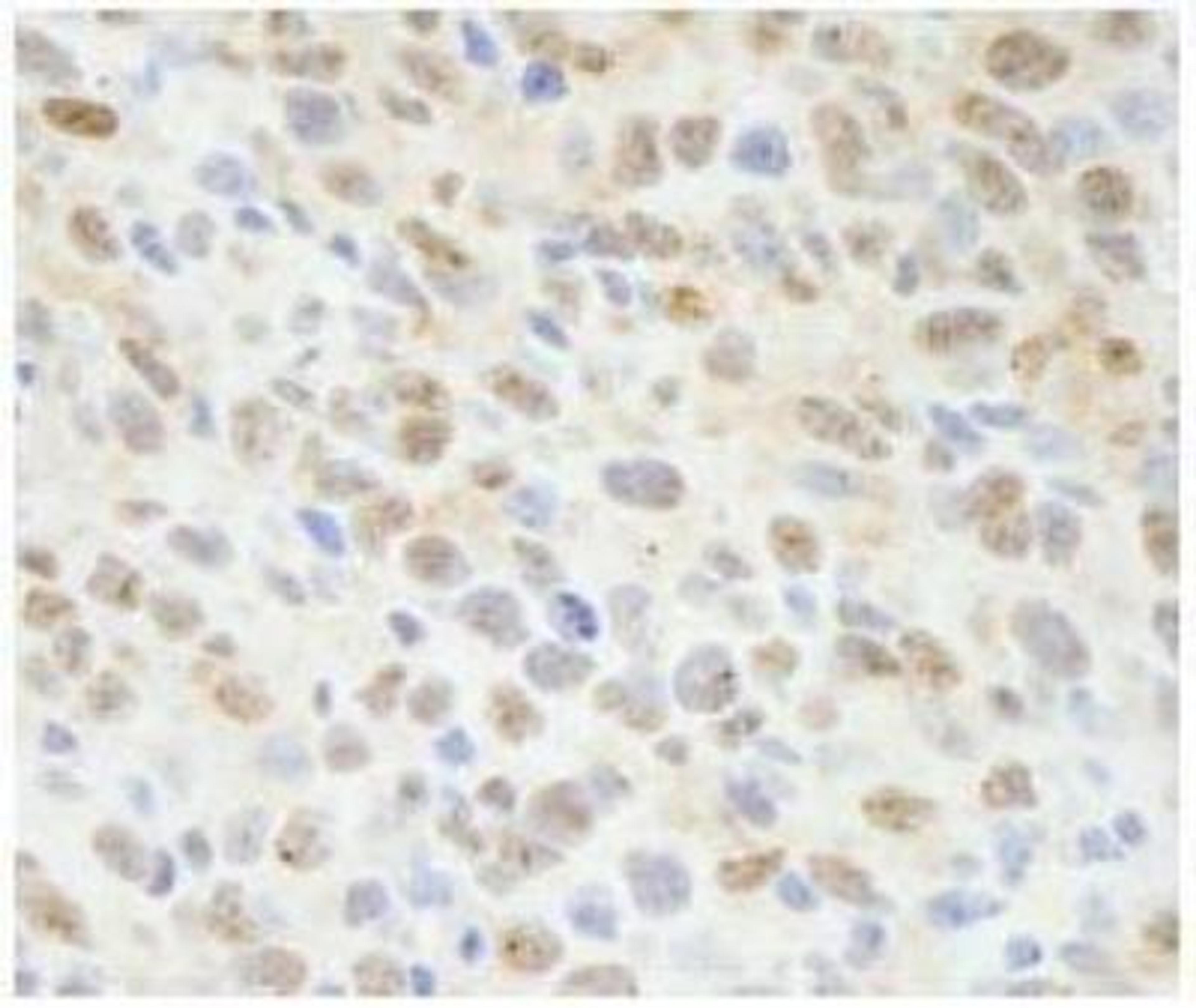 Immunohistochemistry-Paraffin: Sin1/MAPKAP1 Antibody [NB110-40424] -  FFPE section of mouse squamous cell carcinoma. Antibody: Affinity purified rabbit anti-Sin1 used at a dilution of 1:100. Detection: DAB staining using Immunohistochemistry Accessory Kit.