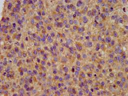 IHC image of CSB-PA22569A0Rb diluted at 1:200 and staining in paraffin-embedded human glioma performed on a Leica BondTM system. After dewaxing and hydration, antigen retrieval was mediated by high pressure in a citrate buffer (pH 6.0). Section was blocked with 10% normal goat serum 30min at RT. Then primary antibody (1% BSA) was incubated at 4°C overnight. The primary is detected by a biotinylated secondary antibody and visualized using an HRP conjugated SP system.
