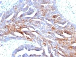 IHC staining of human ovarian carcinoma with TAG-72 antibody