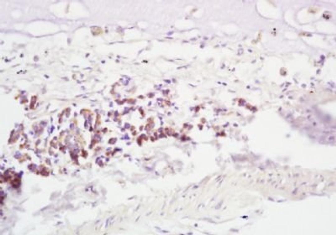 Immunohistochemical analysis of formalin-fixed paraffin embedded human lung carcinoma tissue using RNF43 antibody (dilution at 1:200)