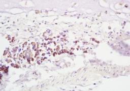 Immunohistochemical analysis of formalin-fixed paraffin embedded human lung carcinoma tissue using RNF43 antibody (dilution at 1:200)