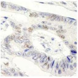 Immunohistochemistry-Paraffin: Symplekin Antibody [NB100-74592] - FFPE section of human colon carcinoma.  Affinity purified rabbit anti-Symplekin used at a dilution of 1:250. Detection: DAB staining using Immunohistochemistry Accessory Kit