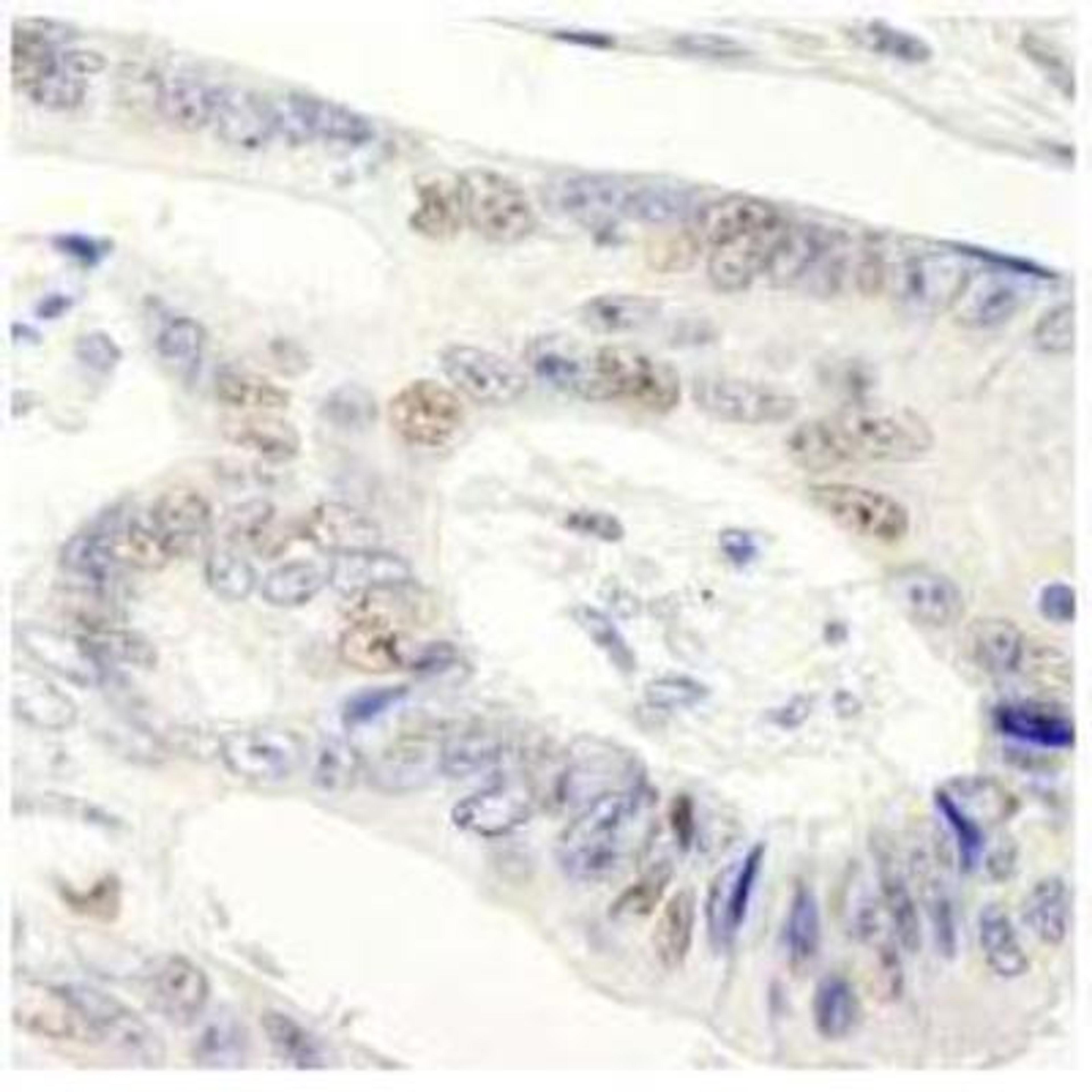 Immunohistochemistry-Paraffin: Symplekin Antibody [NB100-74592] - FFPE section of human colon carcinoma.  Affinity purified rabbit anti-Symplekin used at a dilution of 1:250. Detection: DAB staining using Immunohistochemistry Accessory Kit