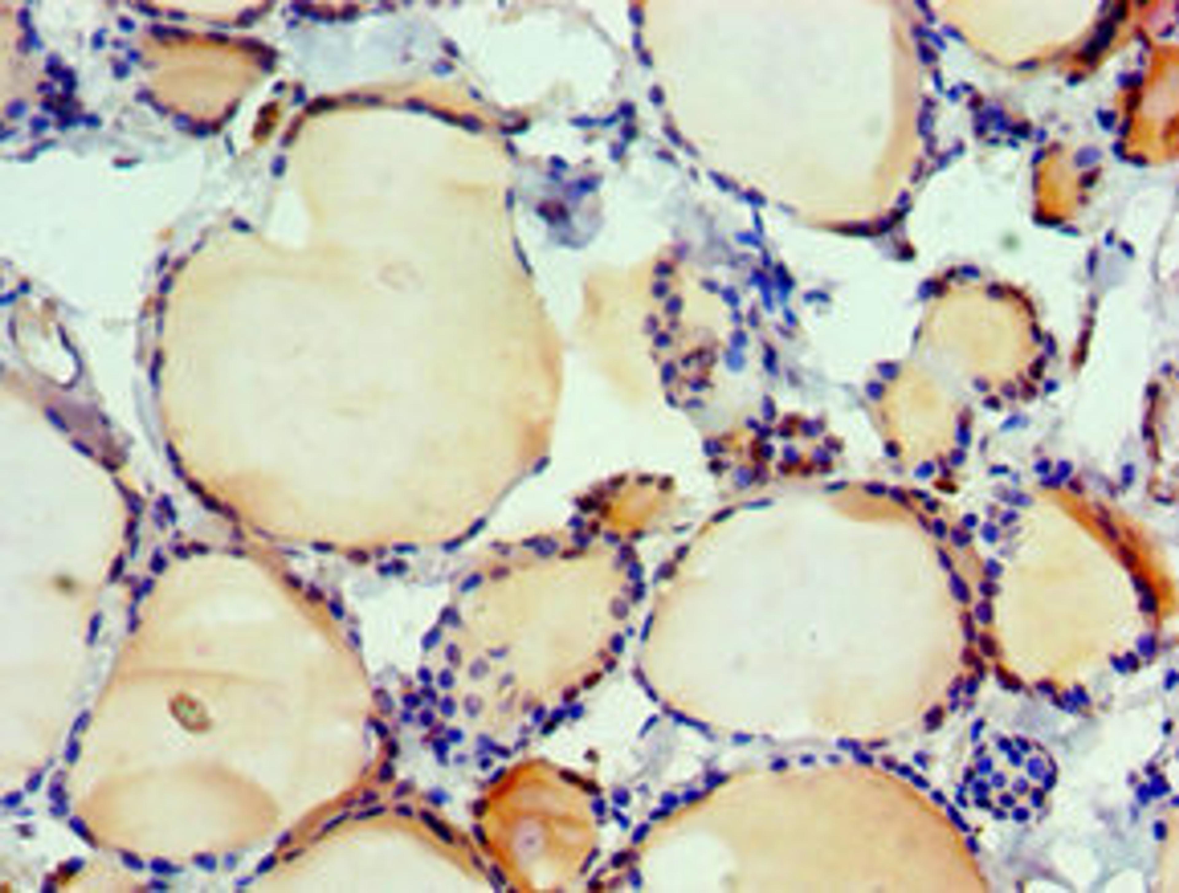 Immunohistochemistry of paraffin-embedded human thyroid tissue using CSB-PA011815ESR1HU at dilution of 1:100
