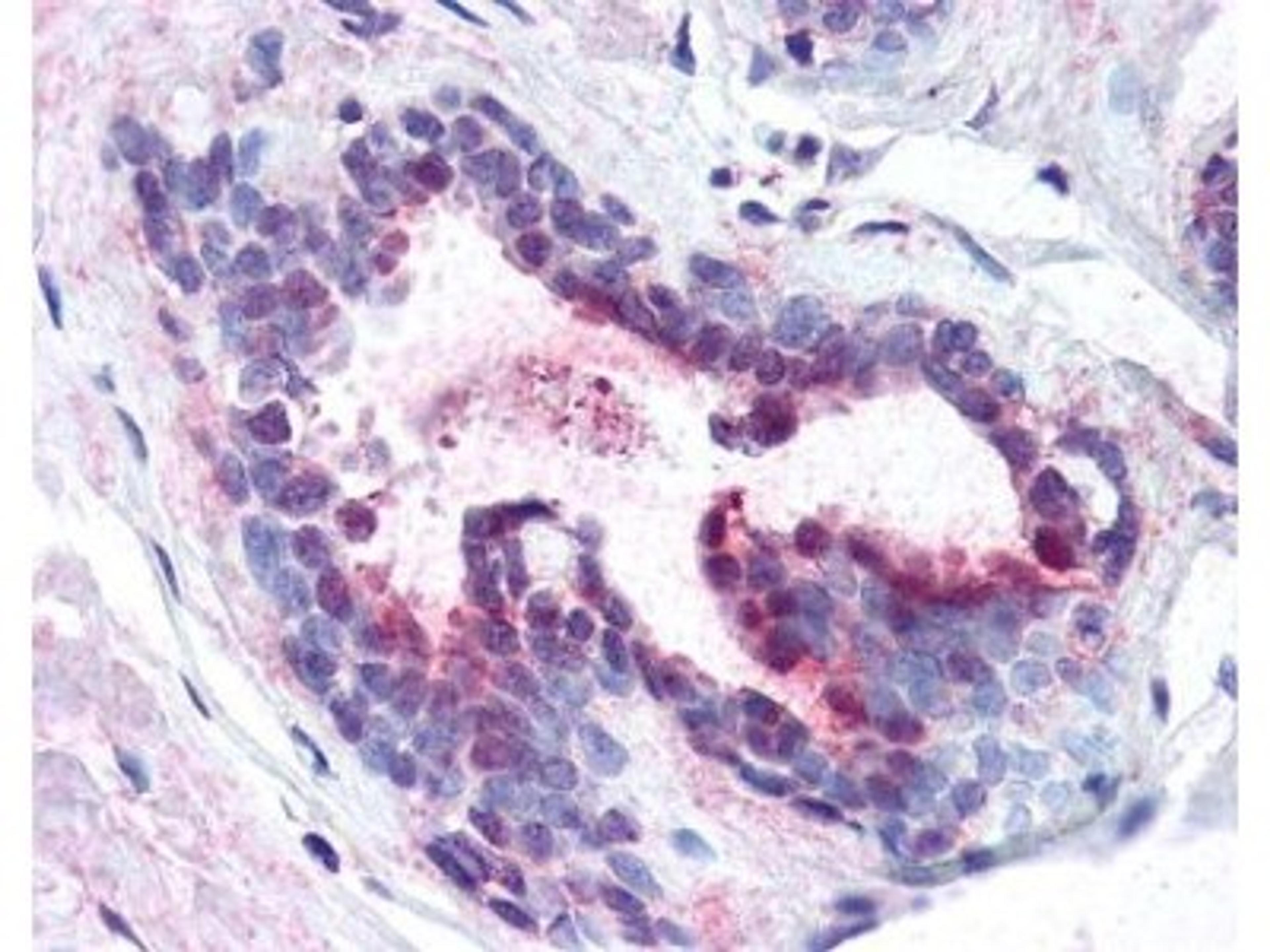 Immunohistochemistry-Paraffin: PDCD4 [p Ser457] Antibody [NB110-60014] - This antibody was used at 1.25ug/mL in a variety of tissues including multi-human, multi-brain and multi-cancer slides. This image shows moderate positive staining of human breast epithelial cells at 40X. The image shows localization of the antibody as the precipitated red signal, with a hematoxylin purple nuclear counterstain.