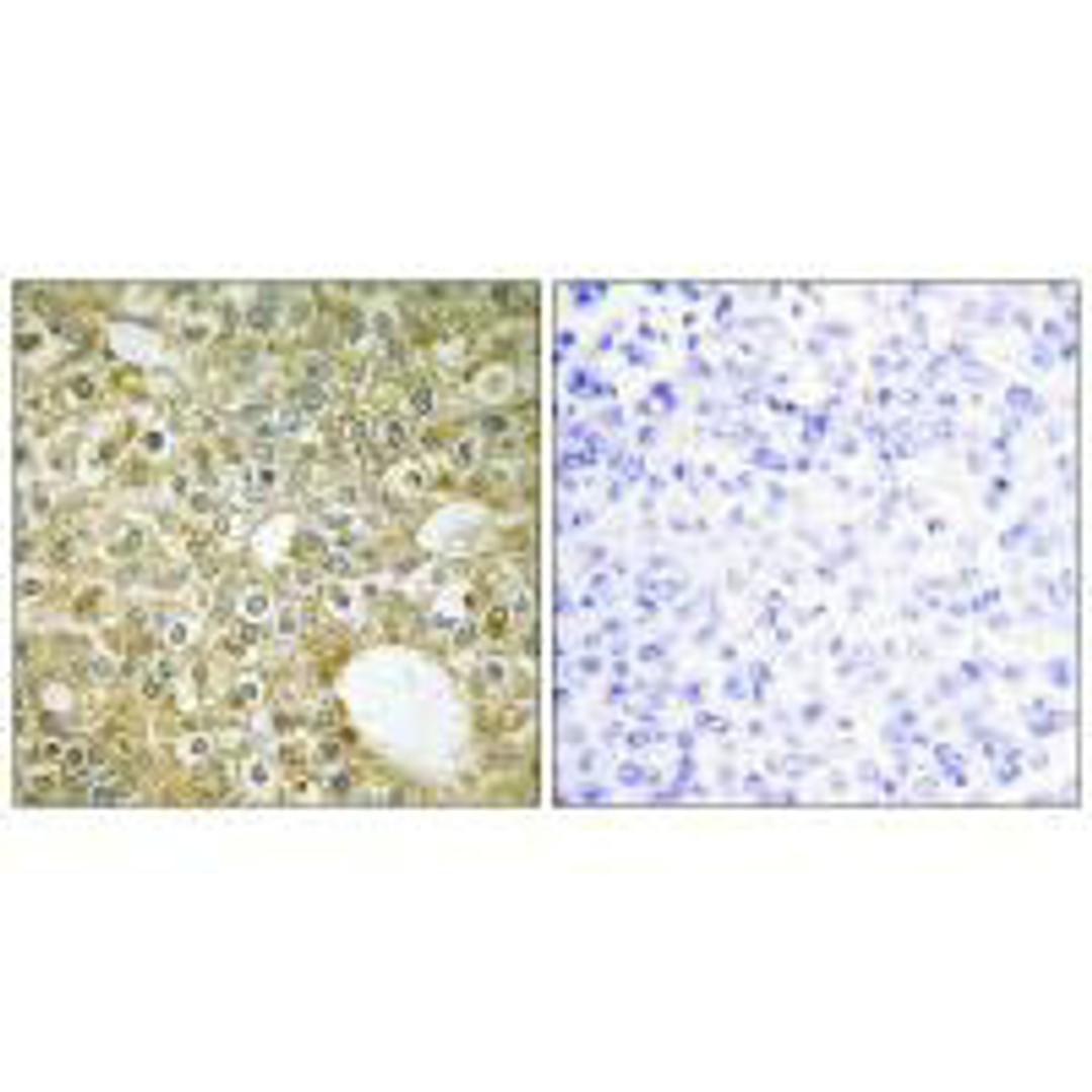 Immunohistochemistry analysis of paraffin-embedded human breast carcinoma tissue using ACVL1 antibody.