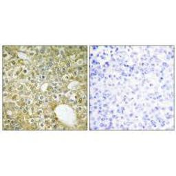 Immunohistochemistry analysis of paraffin-embedded human breast carcinoma tissue using ACVL1 antibody.