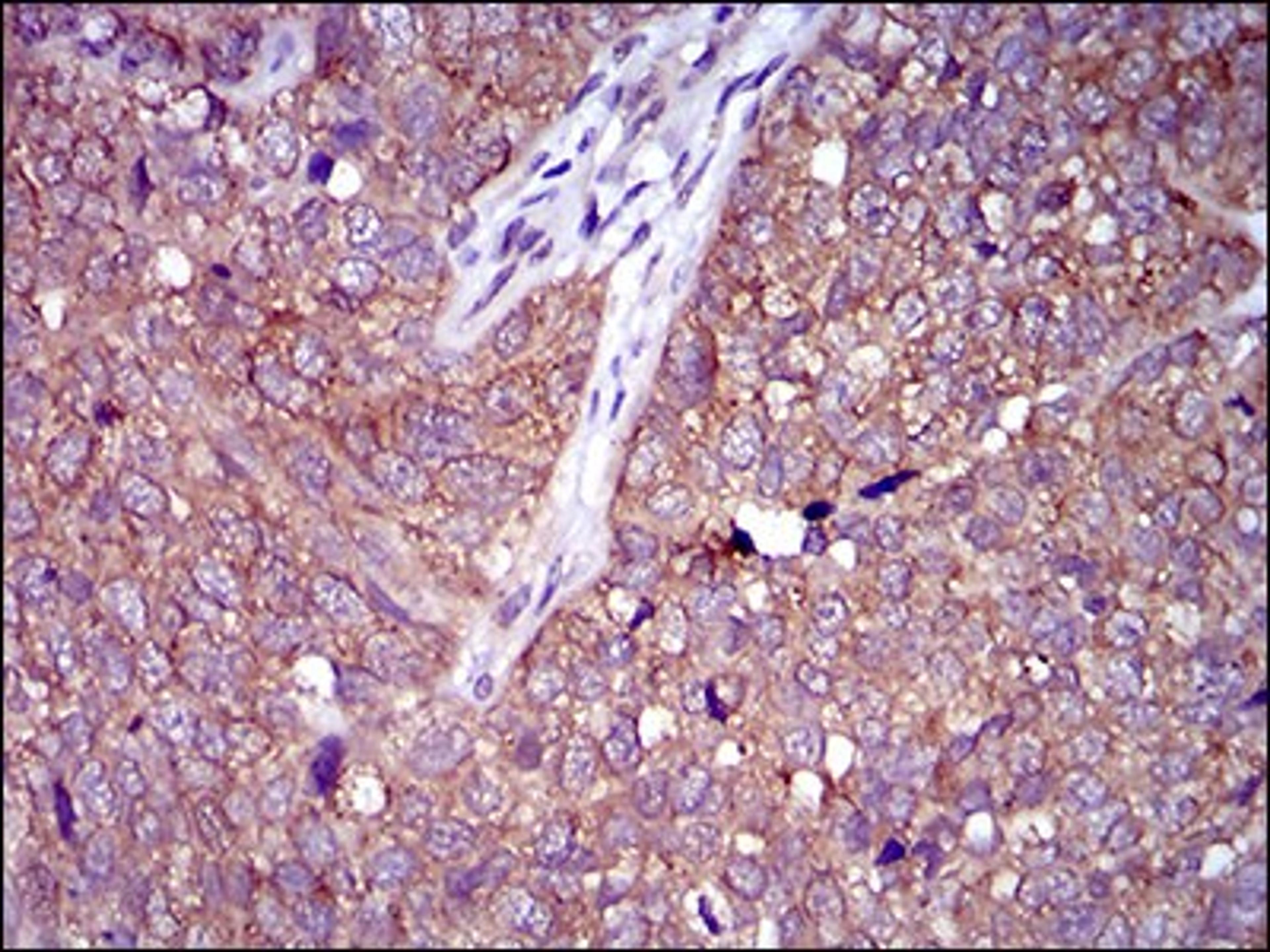 Immunohistochemistry: CLGN Antibody (1C8B6) [NBP2-37348] - Immunohistochemical analysis of paraffin-embedded bladder cancer tissues using CLGN mouse mAb with DAB staining.