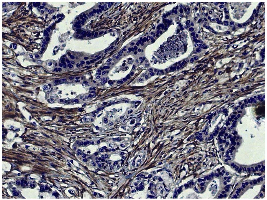 Human gastric cancer tissue was stained with Mouse Anti-Human MMP-2-UNLB (Cat. No. 99-769) followed by HRP conjugated Anti-Mouse Ig secondary antibody.