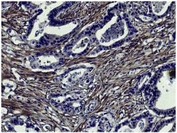 Human gastric cancer tissue was stained with Mouse Anti-Human MMP-2-UNLB (Cat. No. 99-769) followed by HRP conjugated Anti-Mouse Ig secondary antibody.