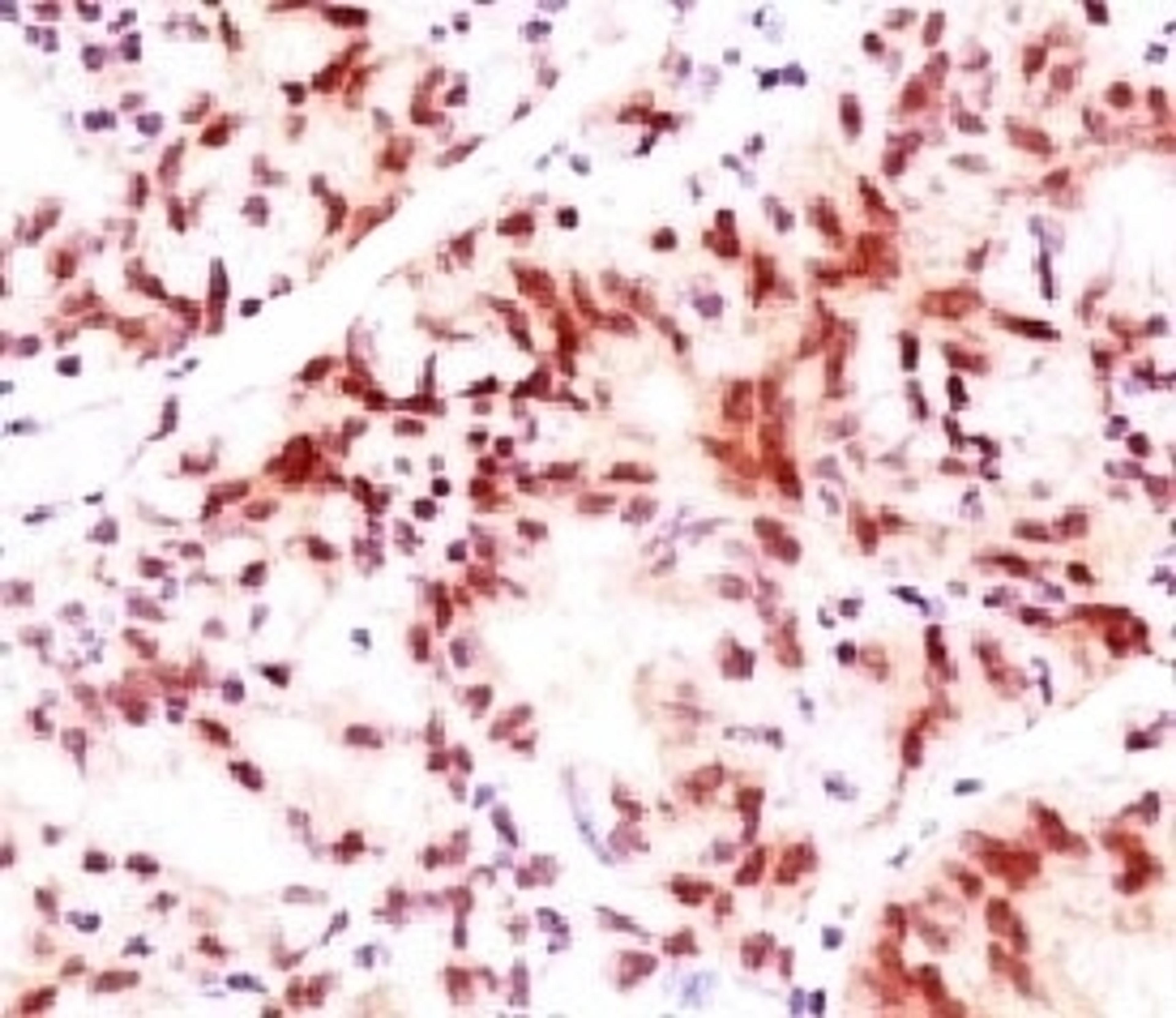 IHC testing of ovarian cancer stained with Estrogen Receptor beta antibody