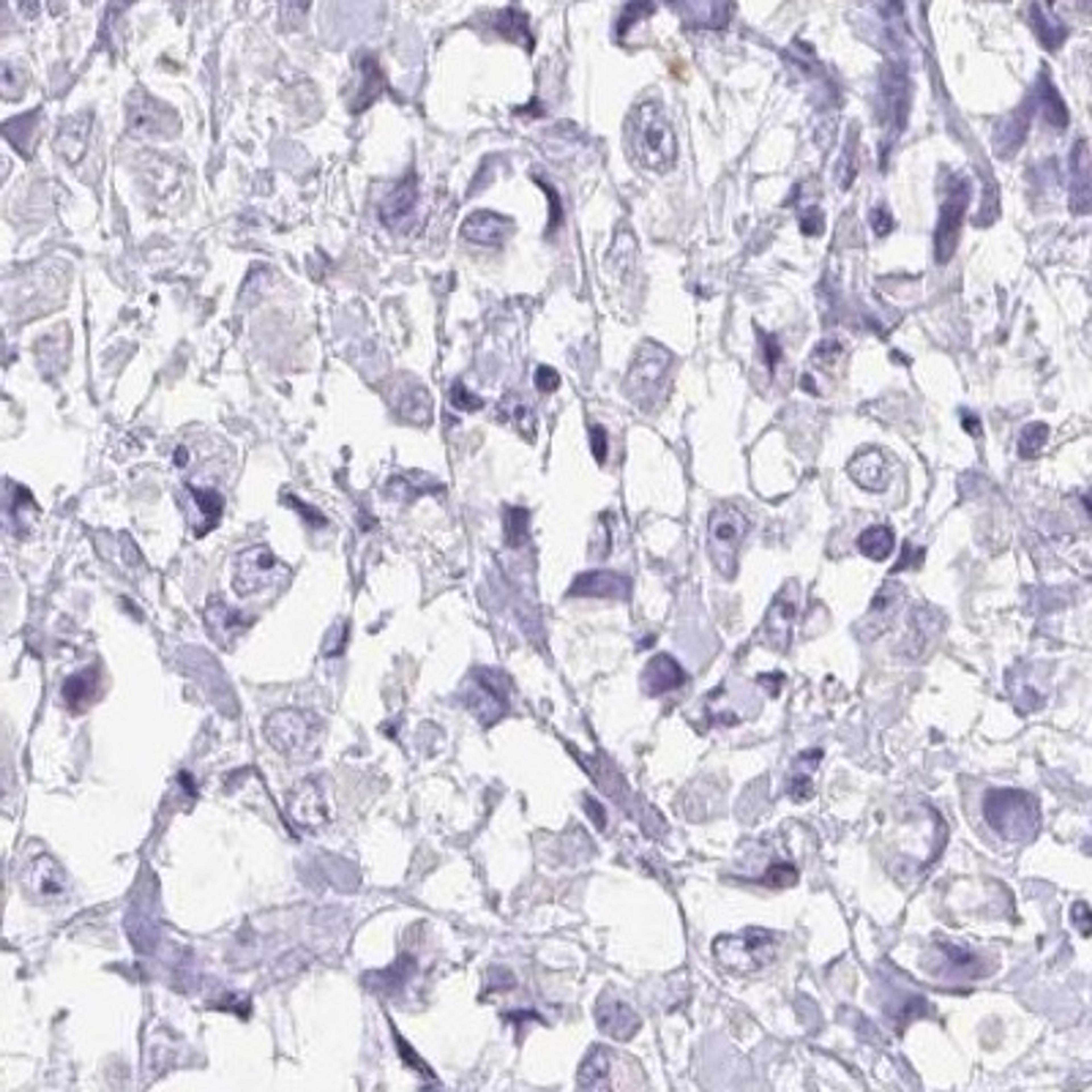 Immunohistochemistry: Protamine 2 Antibody [NBP2-31637] - breast cancer