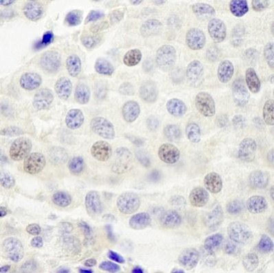 Immunohistochemistry-Paraffin: INT4 Antibody [NB100-60660] - FFPE section of human breast carcinoma.  Affinity purified rabbit anti-INT4 used at a dilution of 1:250.