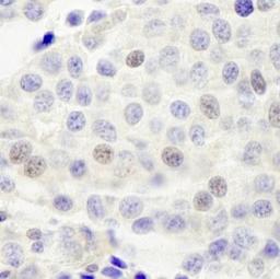 Immunohistochemistry-Paraffin: INT4 Antibody [NB100-60660] - FFPE section of human breast carcinoma.  Affinity purified rabbit anti-INT4 used at a dilution of 1:250.