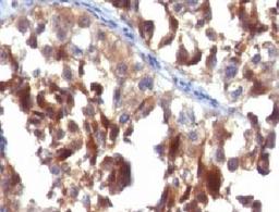 IHC testing of FFPE human melanoma carcinoma with CD63 antibody.