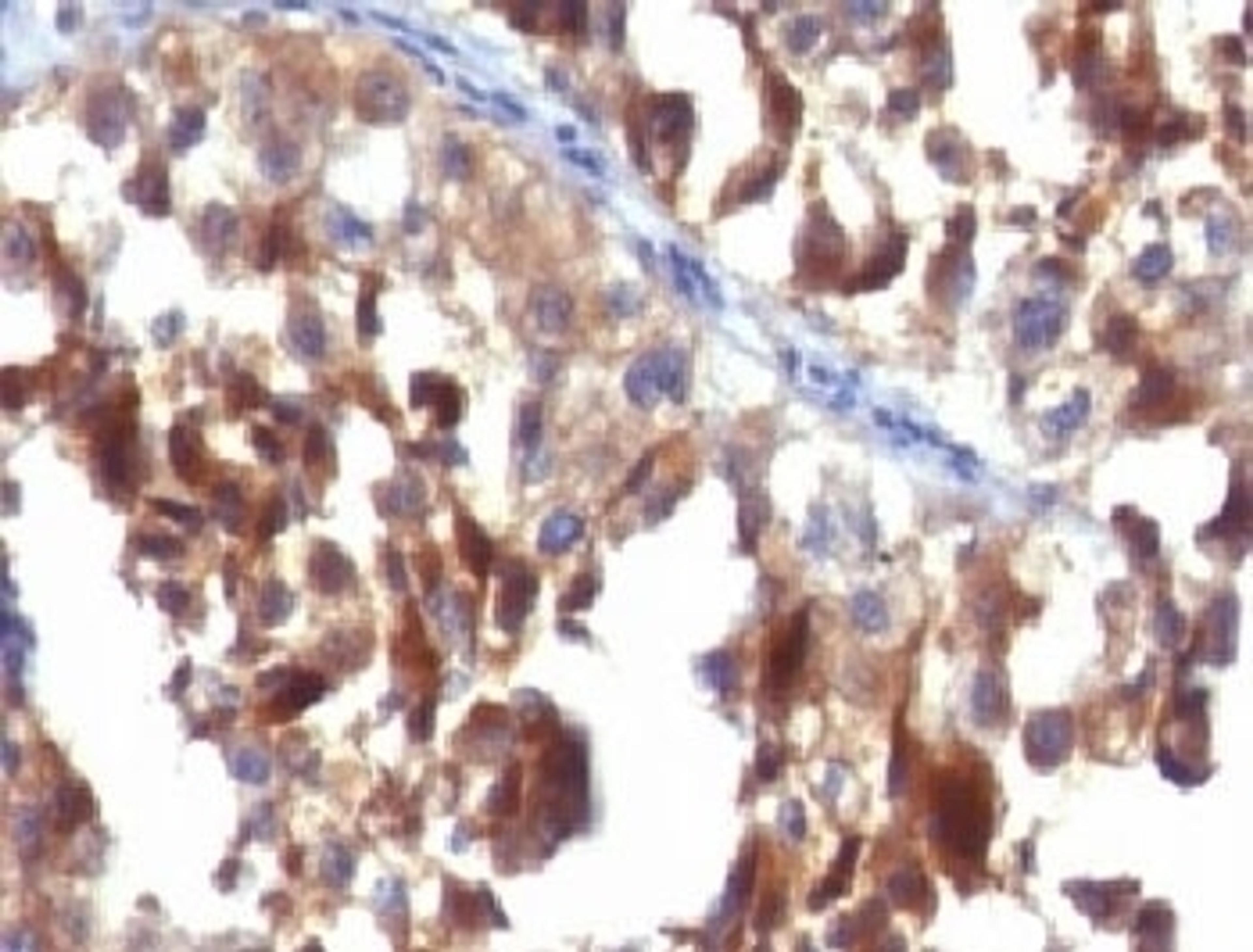 IHC testing of FFPE human melanoma carcinoma with CD63 antibody.