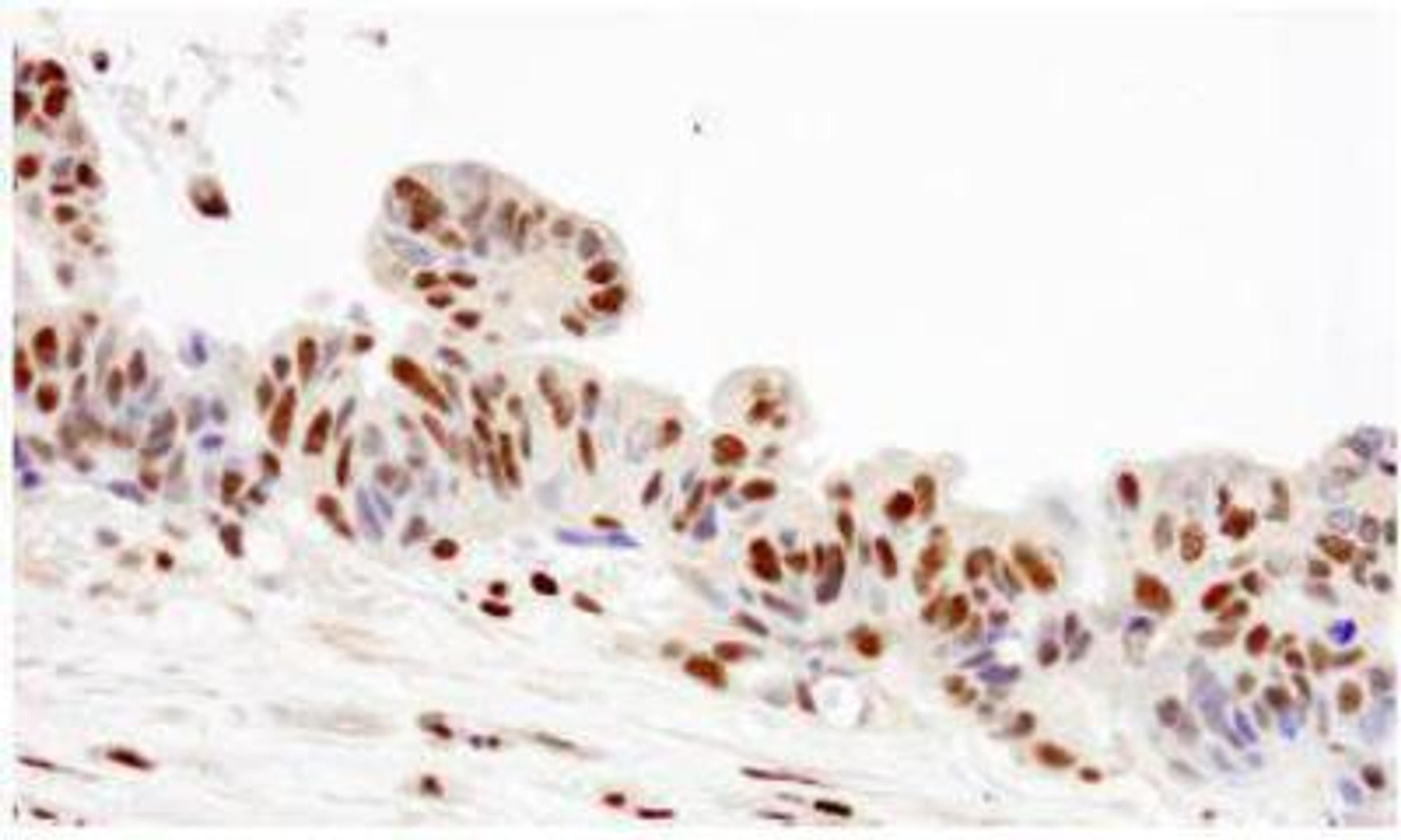 Immunohistochemistry-Paraffin: RPA2 Antibody [NB100-332] - FFPE section of human ovarian tumor.  Affinity purified rabbit anti-RPA32 used at a dilution of 1:250.