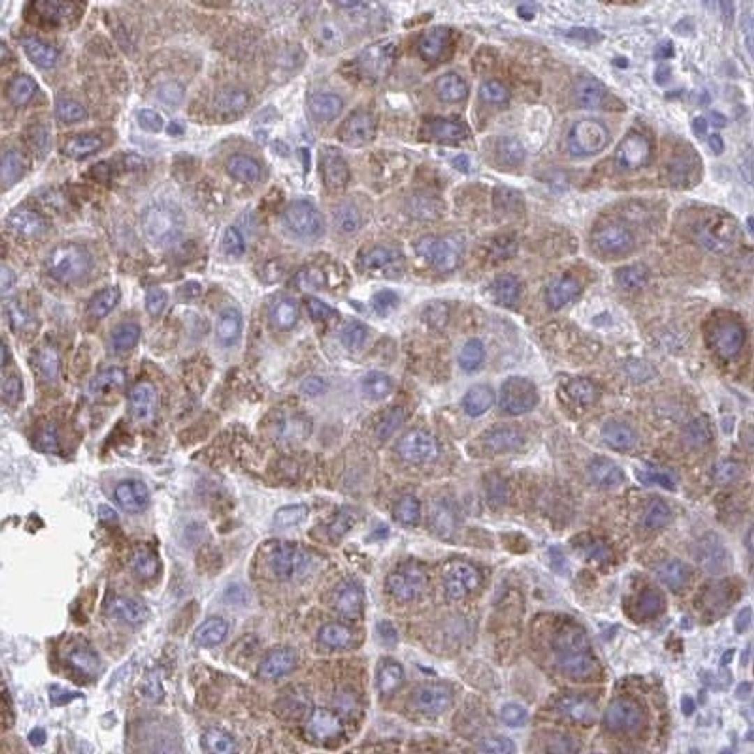 Immunohistochemistry: RHOBTB2 Antibody [NBP2-32576] - liver cancer