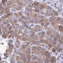 Immunohistochemistry: RHOBTB2 Antibody [NBP2-32576] - liver cancer