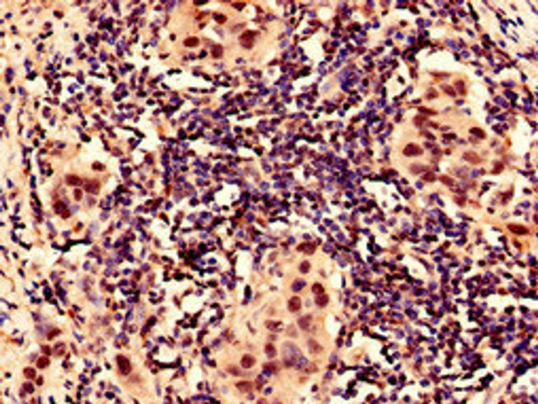 Immunocytochemistry analysis of human bladder cancer using CSB-PA12807A0Rb at dilution of 1:100