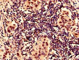 Immunocytochemistry analysis of human bladder cancer using CSB-PA12807A0Rb at dilution of 1:100