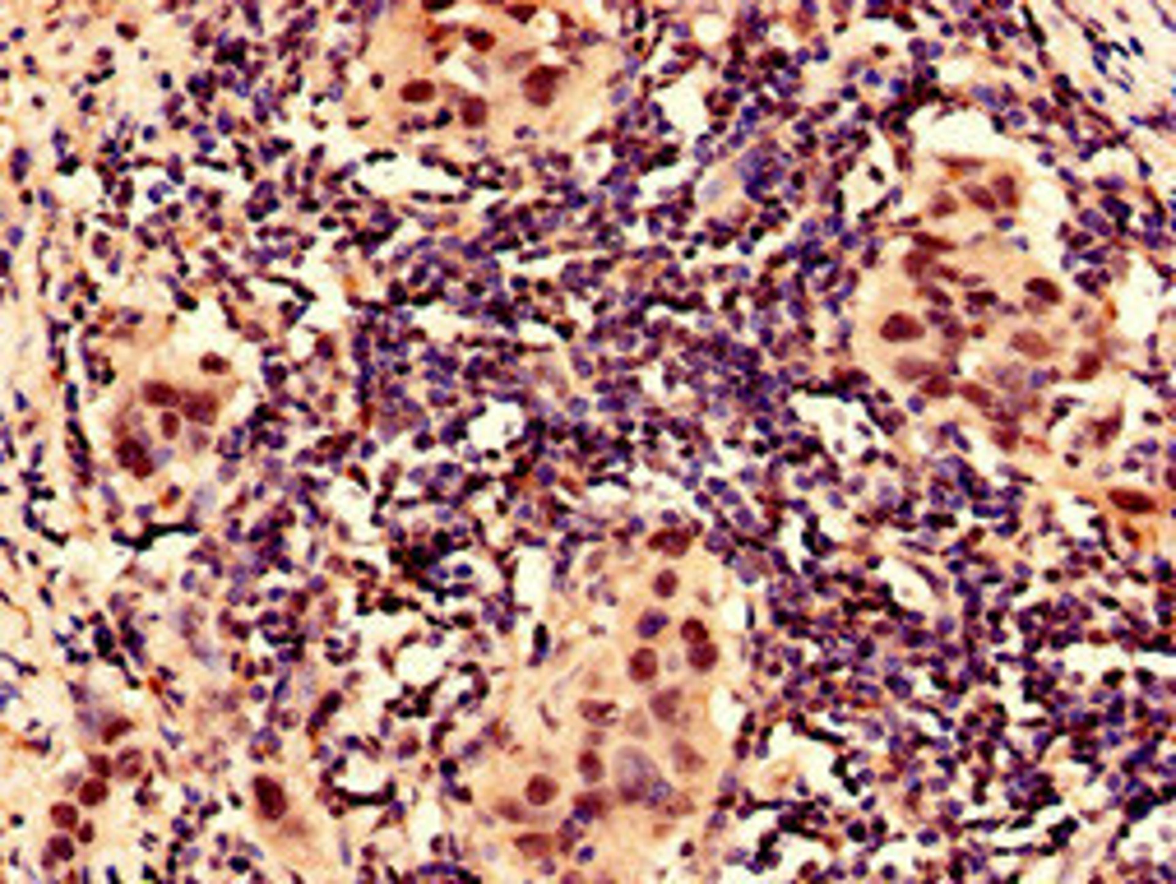 Immunocytochemistry analysis of human bladder cancer using CSB-PA12807A0Rb at dilution of 1:100