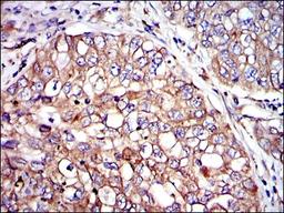 Immunohistochemistry: Crk Antibody (3G11E8) [NBP2-37568] - Immunohistochemical analysis of paraffin-embedded lung cancer tissues using CRK mouse mAb with DAB staining.