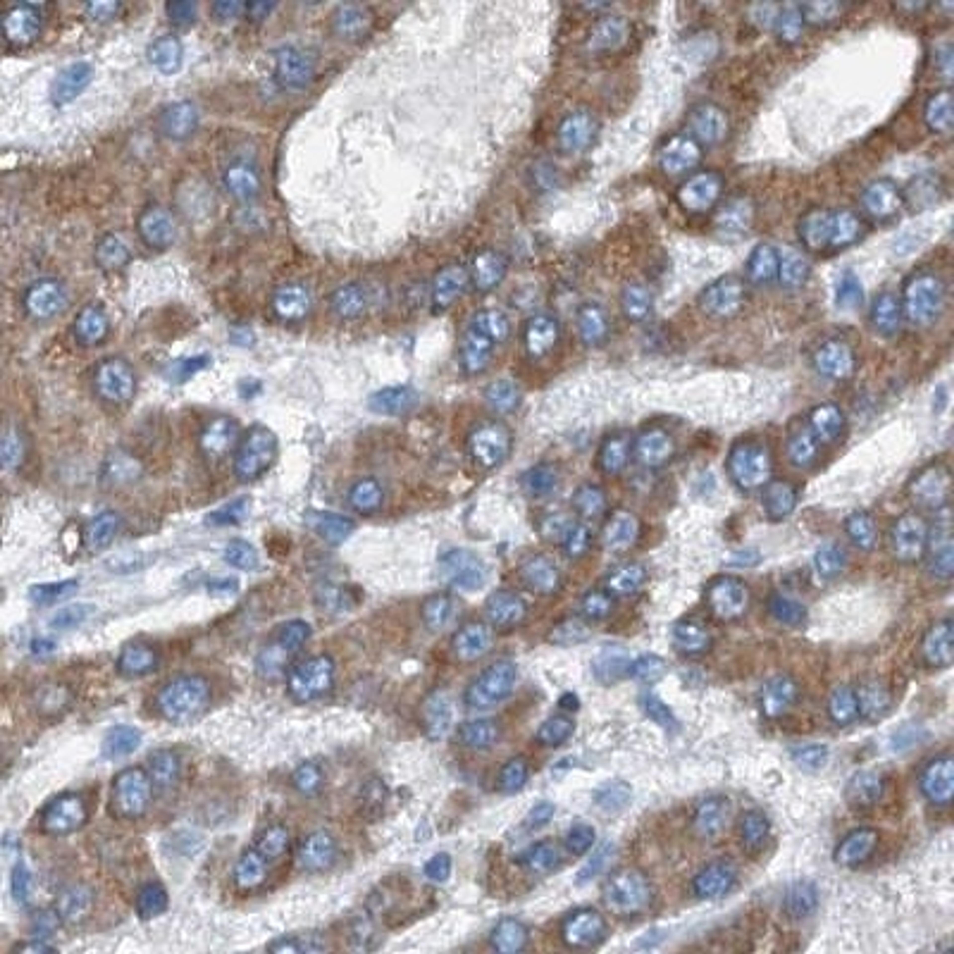 Immunohistochemistry: TRPT1 Antibody [NBP2-32642] - liver cancer