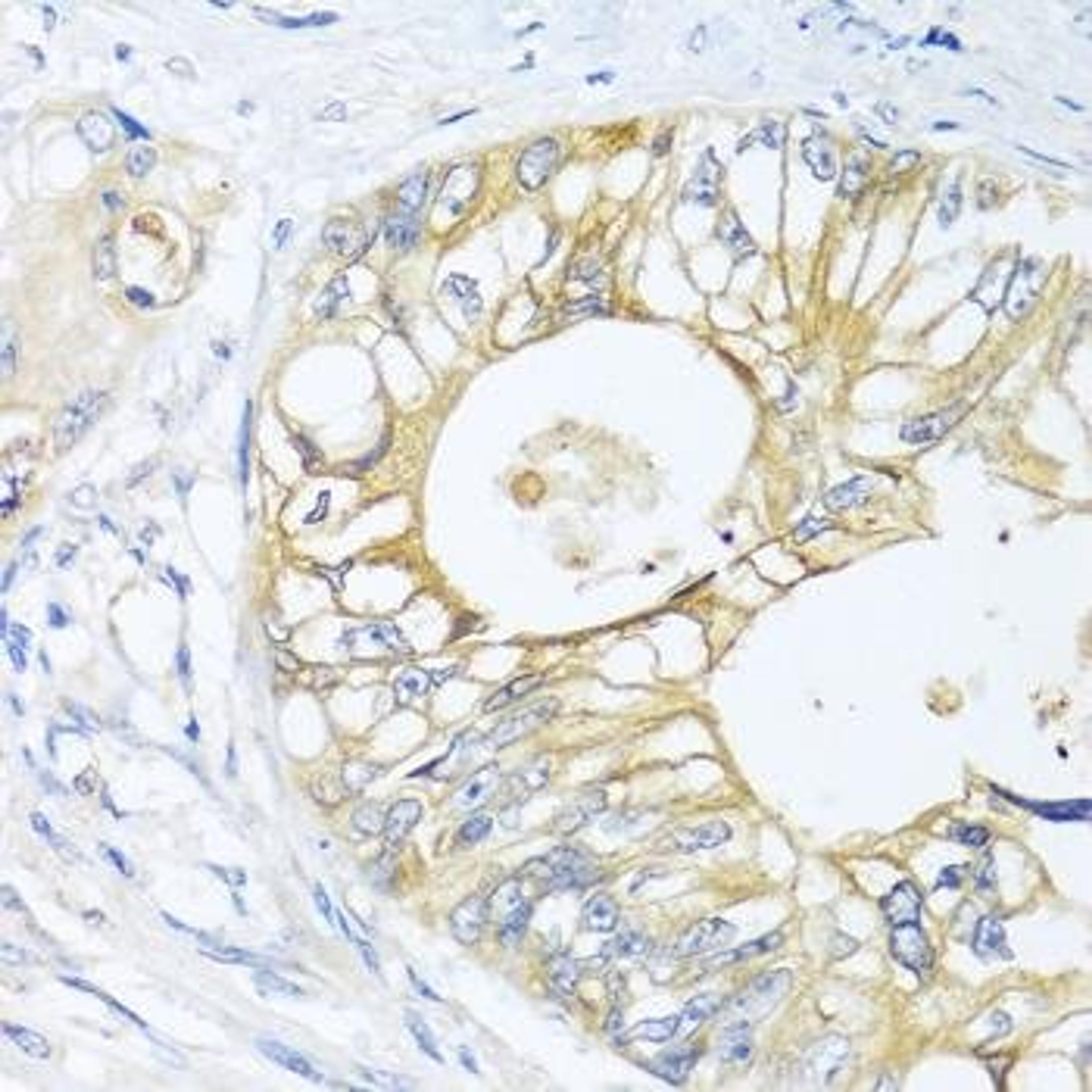 Immunohistochemical staining of human colon carcinoma tissue using GNAI3 antibody (dilution of 1:100)