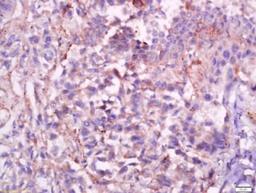 Immunohistochemical staining of human lung carcinoma tissue using C1Q antibody.