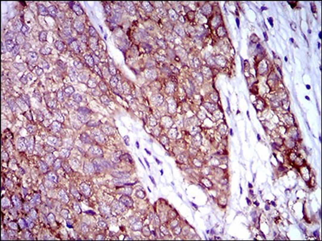 Immunohistochemistry: Rex-1/ZFP42 Antibody (5E11A6) [NBP2-37357] - Immunohistochemical analysis of paraffin-embedded bladder cancer tissues using ZFP42 mouse mAb with DAB staining.