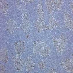 Staining of rat liver, with induced hepatocellular damage, with Mouse anti Rat CD68, clone ED1