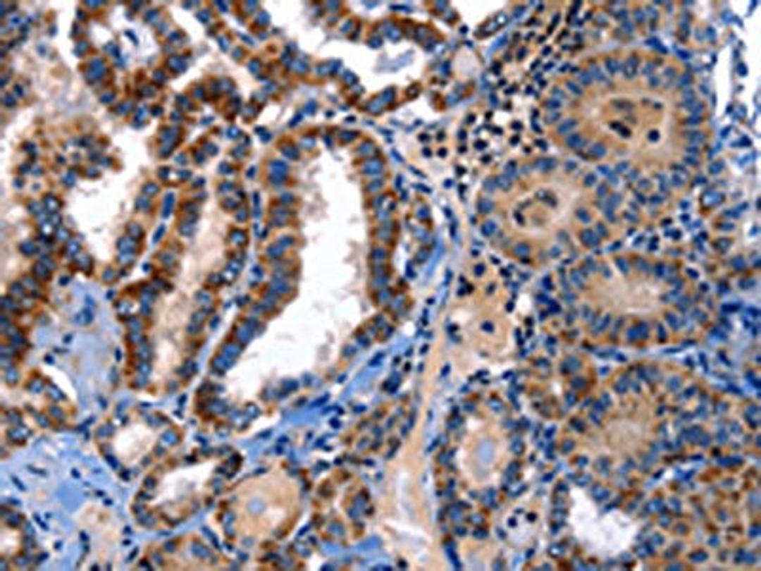 The image on the left is immunohistochemistry of paraffin-embedded Human thyroid cancer tissue using CSB-PA554957(STAT5A Antibody) at dilution 1/25, on the right is treated with fusion protein. (Original magnification: ×200)