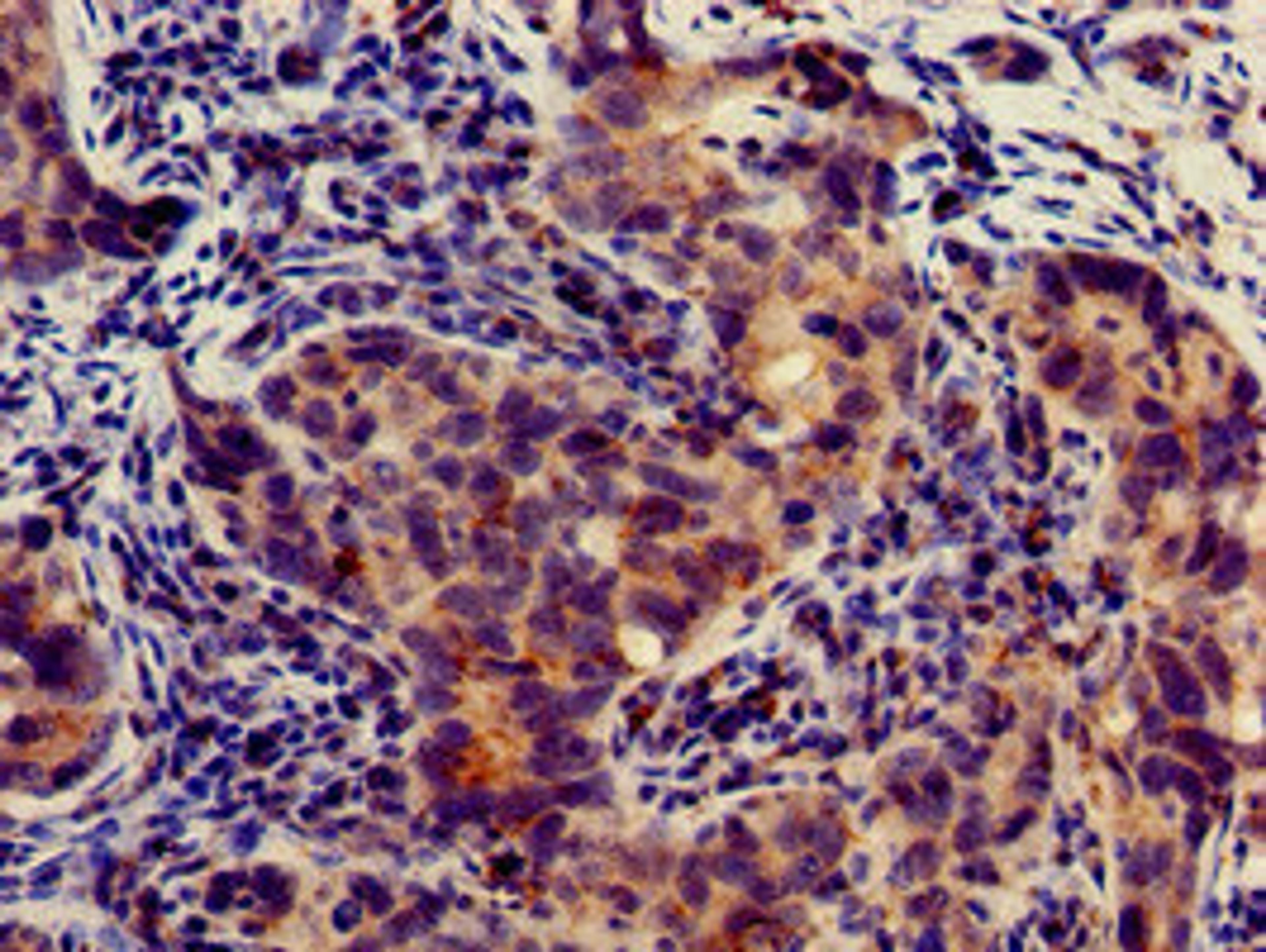Immunohistochemistry of paraffin-embedded human pancreatic cancer using CSB-PA842743LA01HU at dilution of 1:100