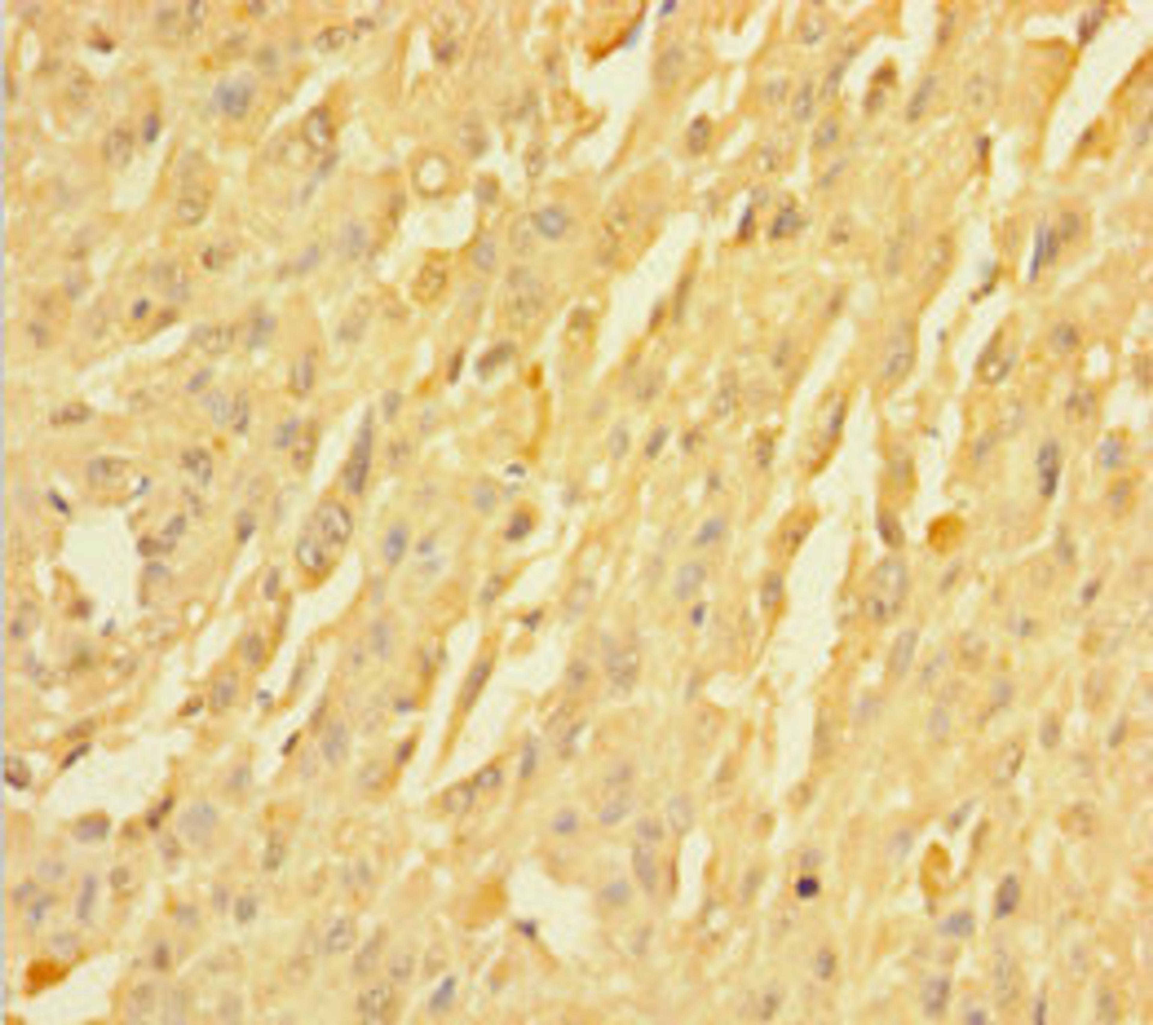 Immunohistochemistry of paraffin-embedded human melanoma using CSB-PA03899A0Rb at dilution of 1:100