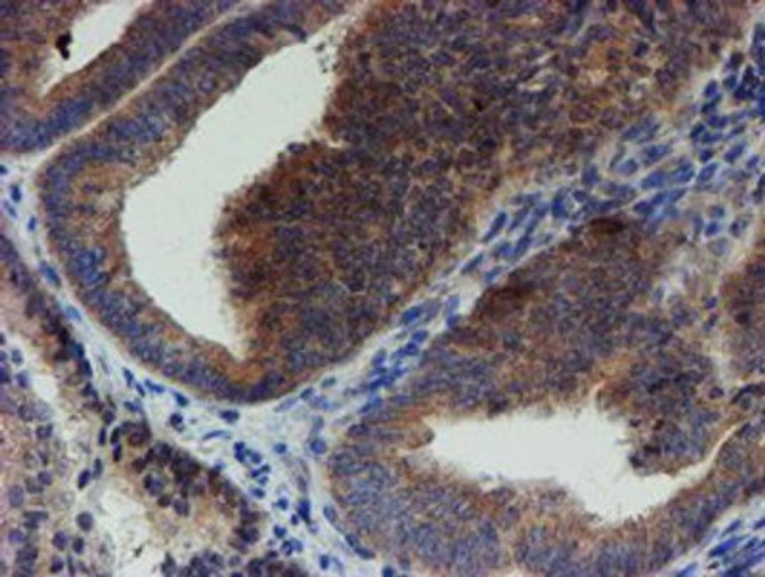 Immunohistochemistry-Paraffin: ZNF365 Antibody (1B7) [NBP2-03848] - Staining of paraffin-embedded Adenocarcinoma of Human endometrium tissue using anti-ZNF365 mouse monoclonal antibody.