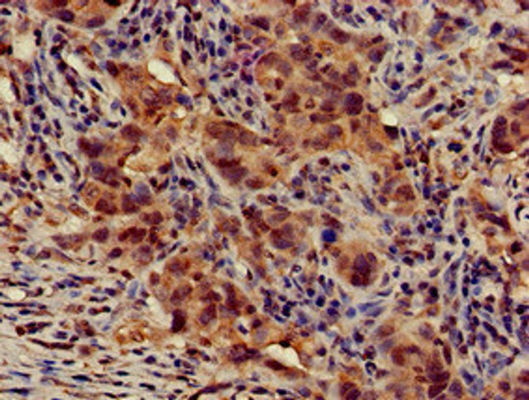 Immunohistochemistry of paraffin-embedded human pancreatic cancer using CSB-PA741052LA01HU at dilution of 1:100