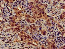 Immunohistochemistry of paraffin-embedded human pancreatic cancer using CSB-PA741052LA01HU at dilution of 1:100