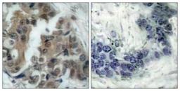 Immunohistochemistry-Paraffin: Bad [p Ser136] Antibody [NBP1-60780] - Analysis of paraffin-embedded human breast carcinoma, using Bad (Phospho-Ser136) Antibody. The picture on the right is treated with the synthesized peptide.