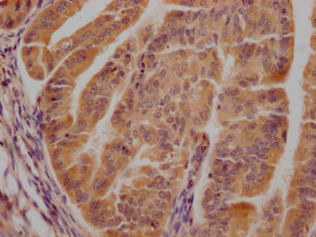 IHC image of CSB-PA005074LA01HU diluted at 1:300 and staining in paraffin-embedded human endometrial cancer performed on a Leica BondTM system. After dewaxing and hydration, antigen retrieval was mediated by high pressure in a citrate buffer (pH 6.0). Section was blocked with 10% normal goat serum 30min at RT. Then primary antibody (1% BSA) was incubated at 4°C overnight. The primary is detected by a Goat anti-rabbit polymer IgG labeled by HRP and visualized using 0.05% DAB.