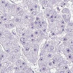 Immunohistochemistry: CAPSL Antibody [NBP2-32387] - liver cancer