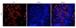 Immunofluorescence analysis of human breast cancer tissue using anti-Integrin alpha 4 (dilution of primary antibody - 1:100)