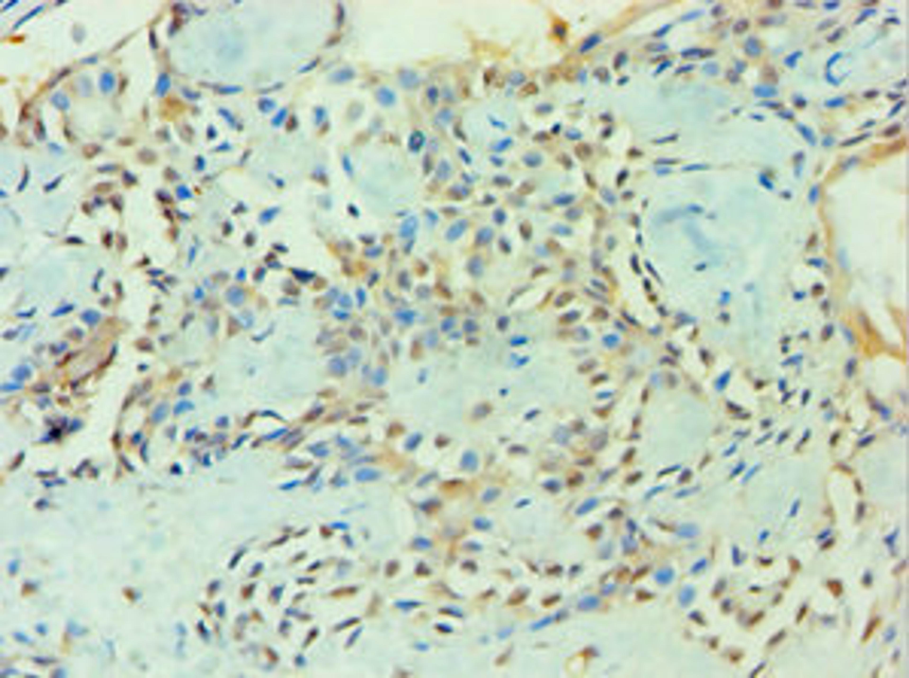 Immunohistochemistry of paraffin-embedded human breast cancer using CSB-PA026691ESR1HU at dilution of 1:100