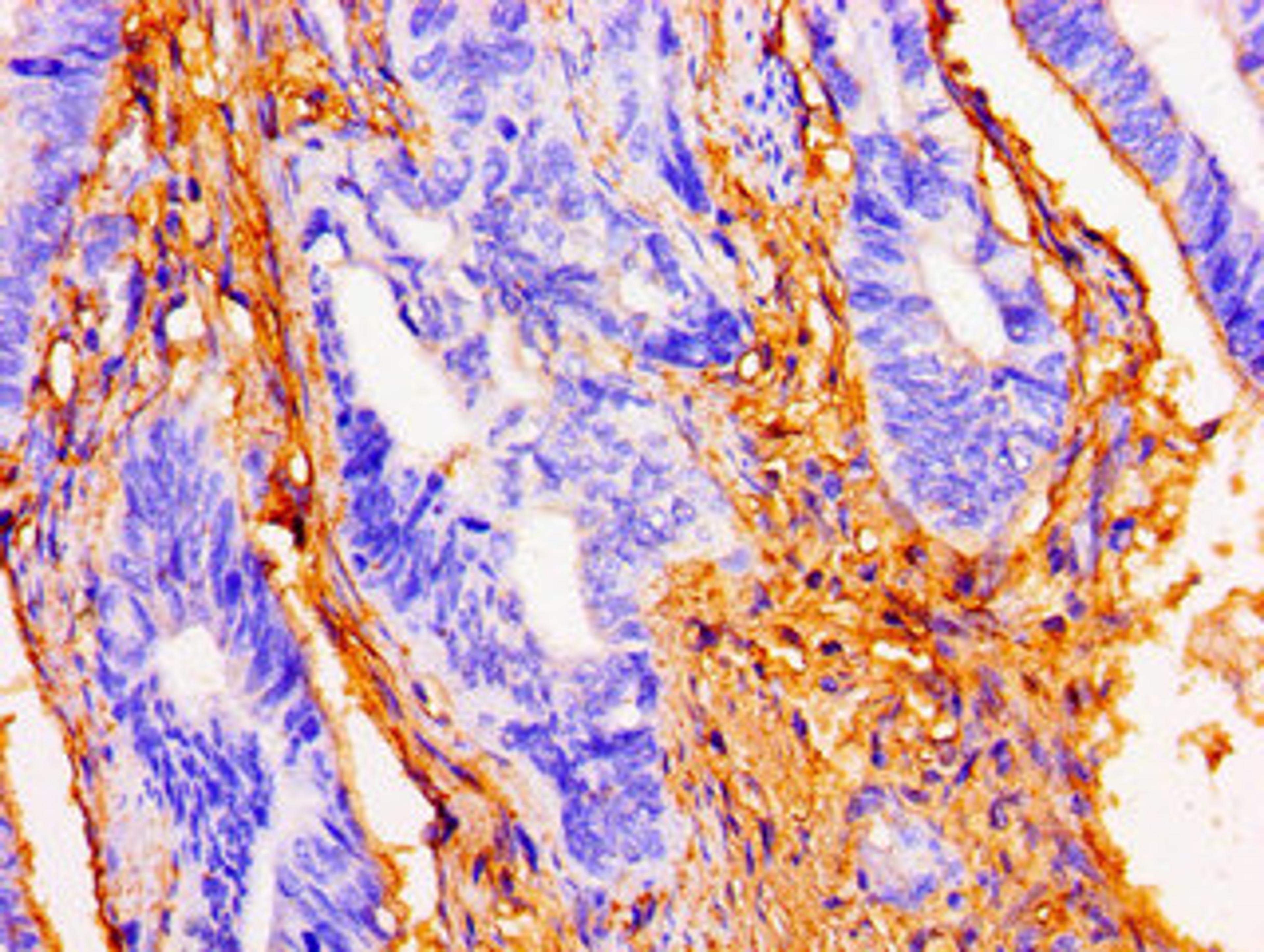 Immunohistochemistry of paraffin-embedded human colon cancer using CSB-PA861938LA01HU at dilution of 1:100