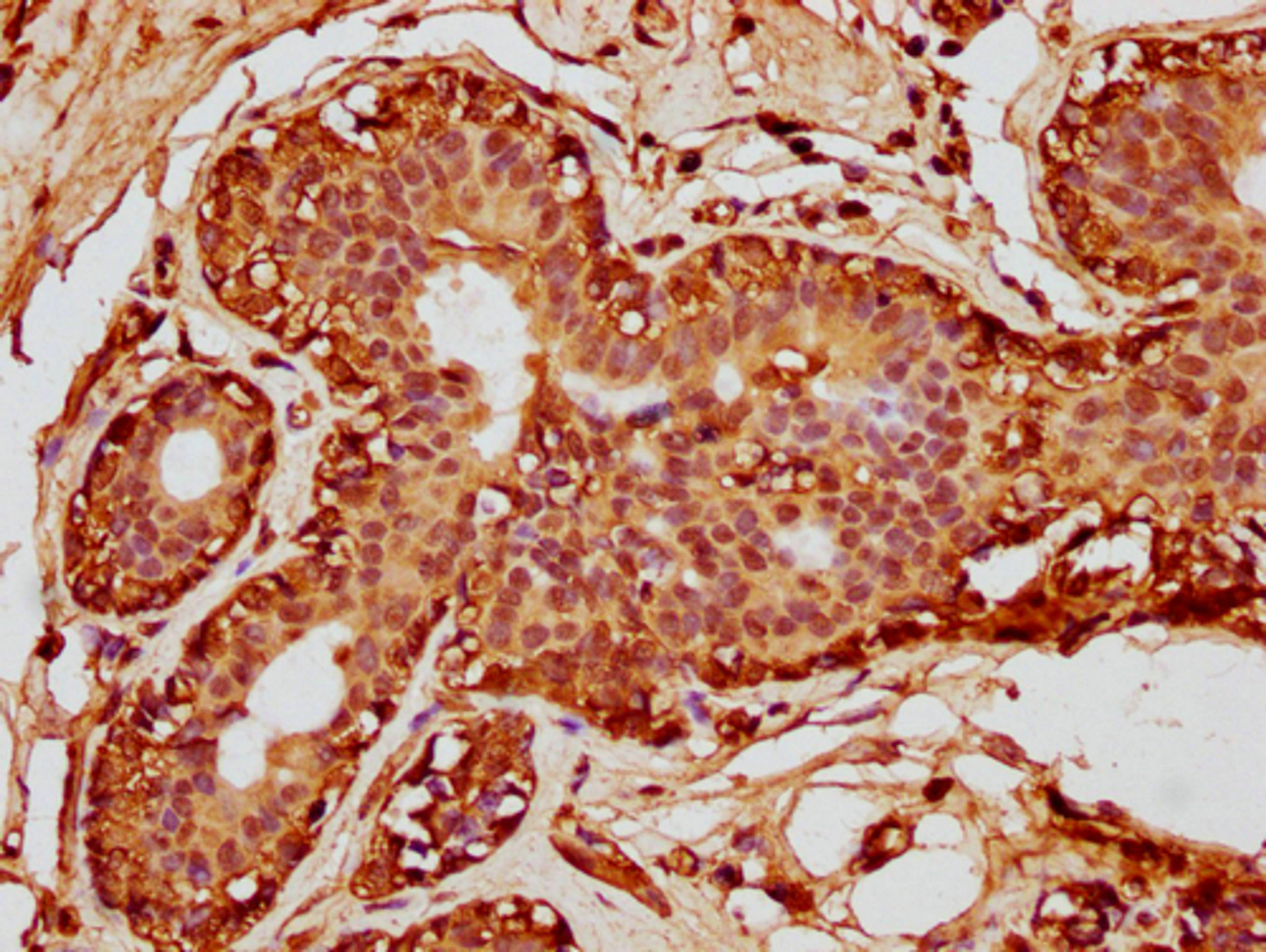 IHC image of CSB-PA010380OA63nforHU diluted at 1:10 and staining in paraffin-embedded human breast cancer performed on a Leica BondTM system. After dewaxing and hydration, antigen retrieval was mediated by high pressure in a citrate buffer (pH 6.0). Section was blocked with 10% normal goat serum 30min at RT. Then primary antibody (1% BSA) was incubated at 4°C overnight. The primary is detected by a biotinylated secondary antibody and visualized using an HRP conjugated SP system.