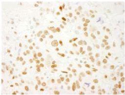 Immunohistochemistry-Paraffin: QKI/Quaking Antibody [NB300-240] - FFPE section of human breast carcinoma.  Affinity purified rabbit anti-QKI used at a dilution of 1:250.